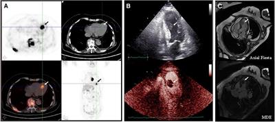 Case Report: A long-term survival case of diffuse large B-cell lymphoma with left ventricular infiltration and spinal cord compression